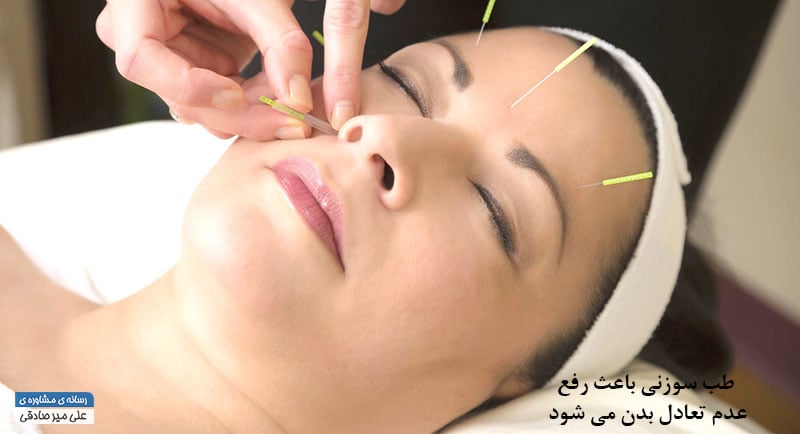 طب سوزنی یکی از روش های طب مکمل طب سوزنی یکی از روش های طب مکمل
